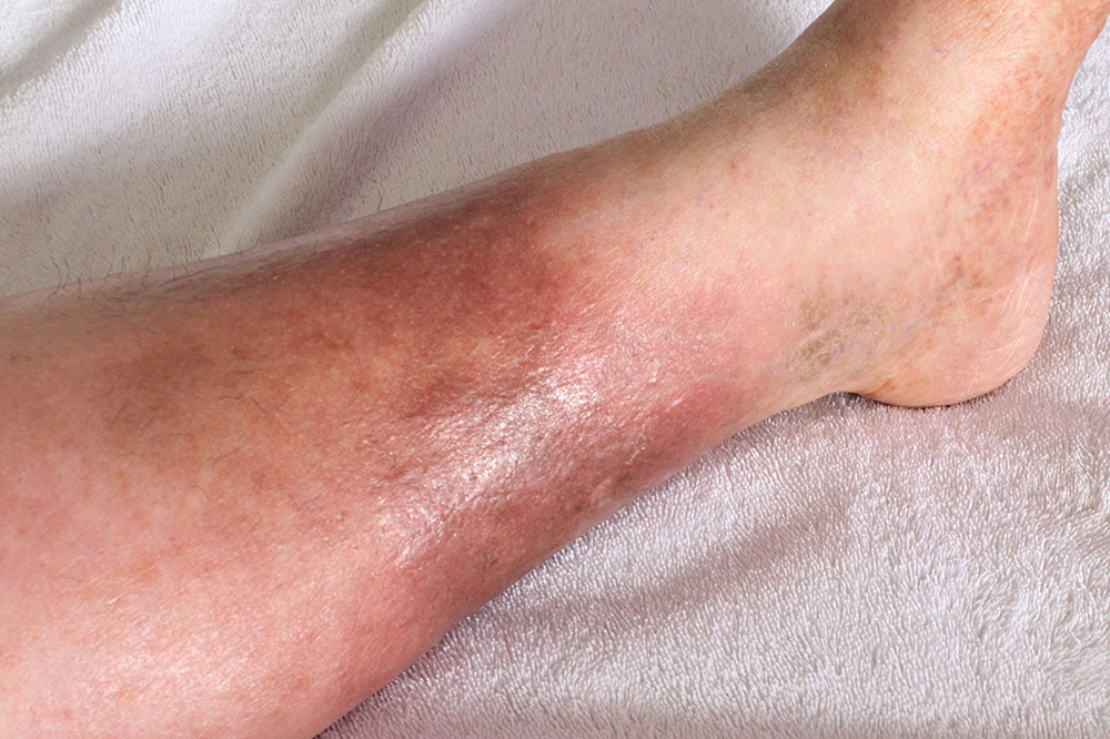 Telltale Symptoms of Deep Vein Thrombosis