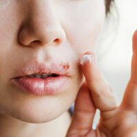 7 Common Cold Sore Triggers