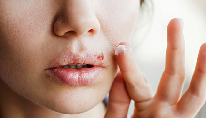 7 Common Cold Sore Triggers