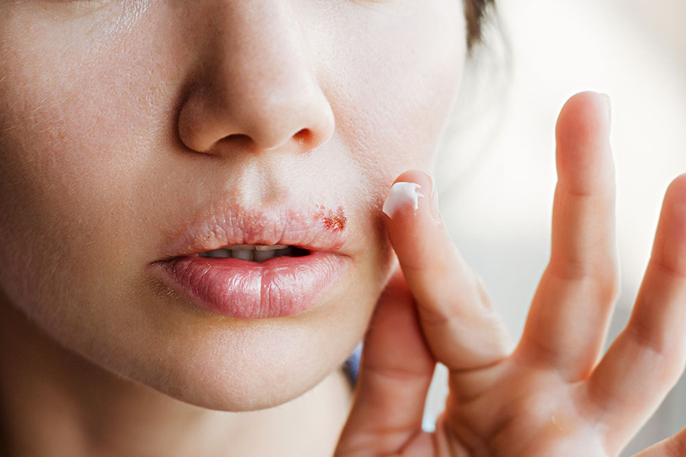 7 Common Cold Sore Triggers