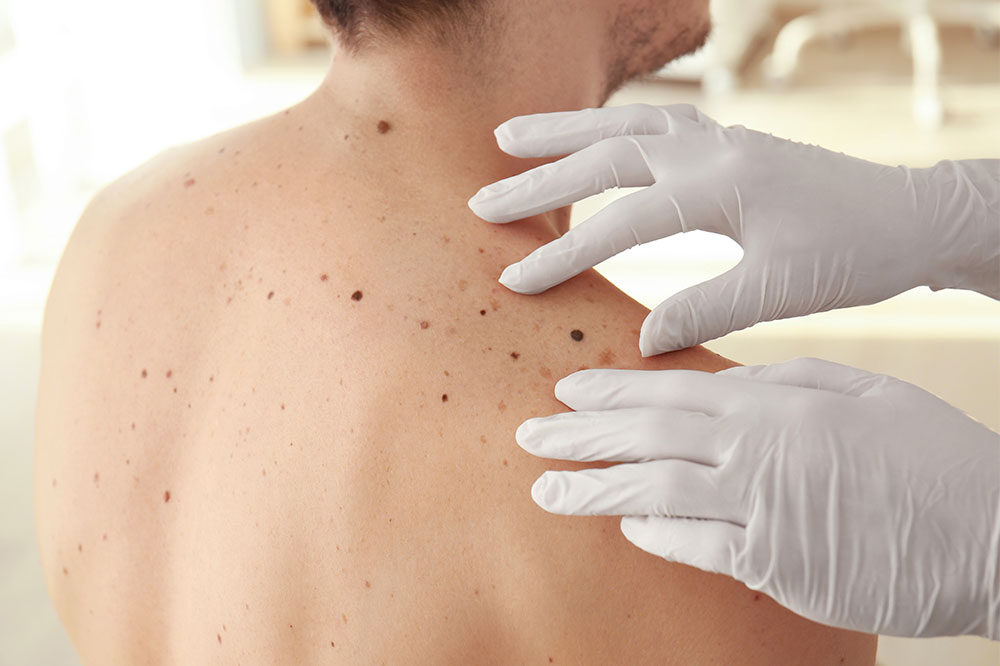 8 Ways to Reduce the Risk of Melanoma